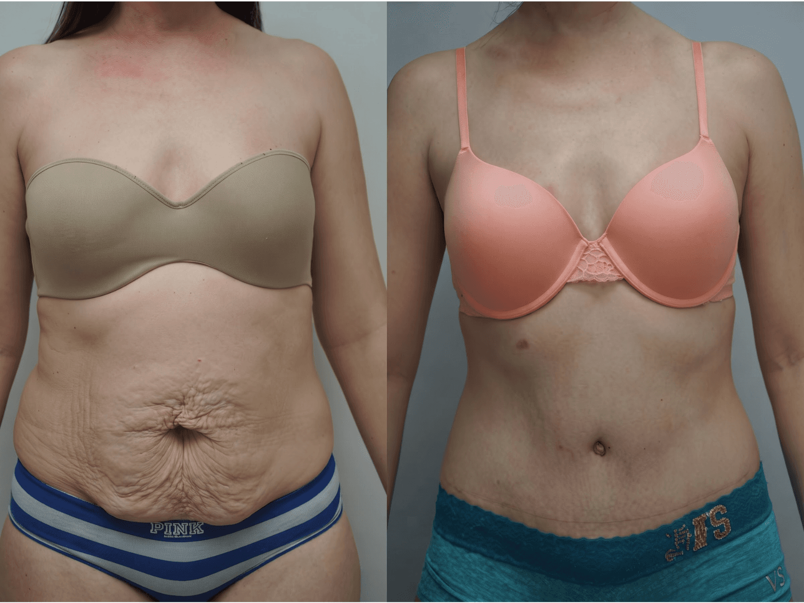 Tummy Tuck (Abdominoplasty)